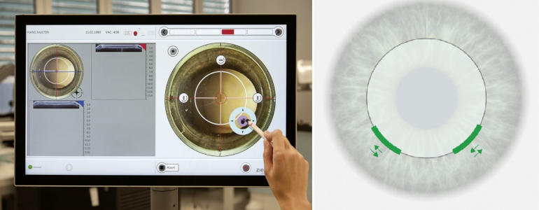 Рефракционная фемтолазерная хирурргия CLEAR - Corneal Lenticule Extraction for Advanced Refractive Correction