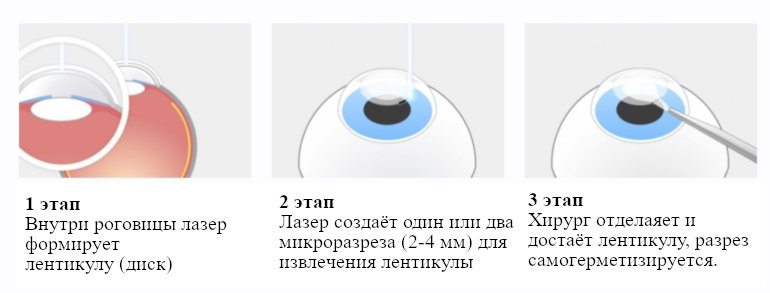 Этапы лазерной коррекции зрения по методу CLEAR (КЛИР)