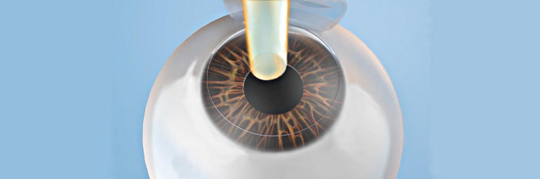 Лазерная коррекция зрения Эпи ЛАСИК (Epi LASIK) Эпи ЛАСИК (Epi LASIK) - лазерная коррекция зрения
