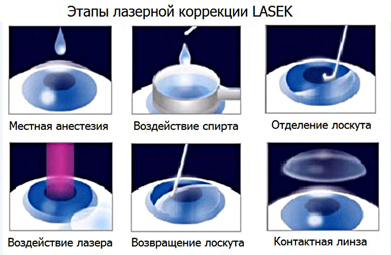 LASEK - лазерная субэпителиальная кератэктомия LASEK - лазерная субэпителиальная кератэктомия
