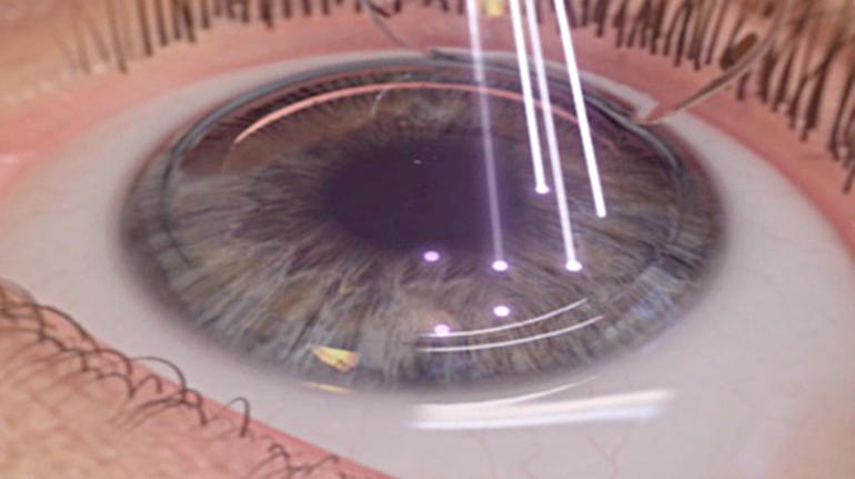Операция LASIK при пресбиопии