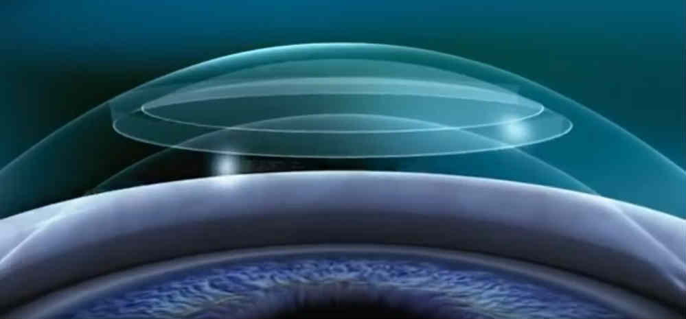 Коррекция зрения лазером ReLEx flex