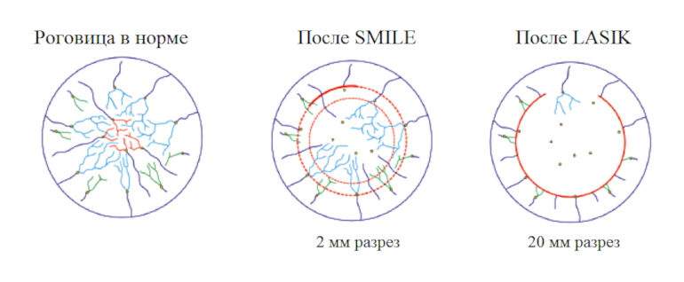 Операция на глаза ReLEx SMILE (СМАЙЛ)