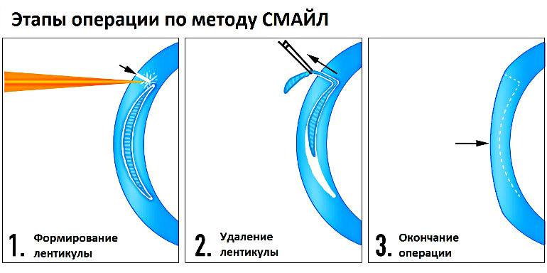 Лазерная коррекция Смайл - отзывы и цены в Москве