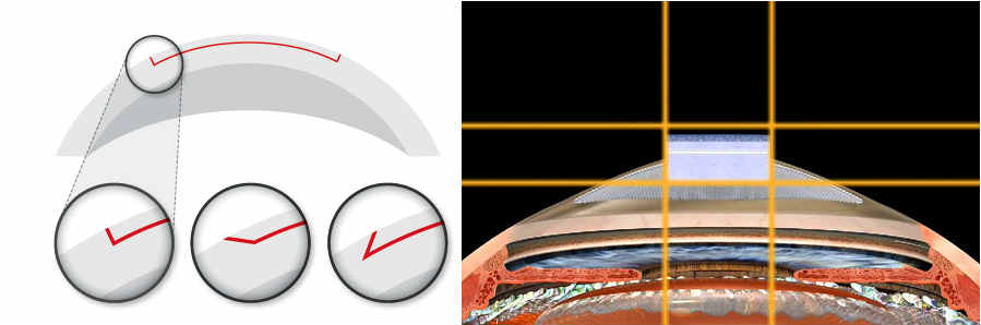 Операция по методу Z-LASIK Метод лазерной коррекции Z-LASIK