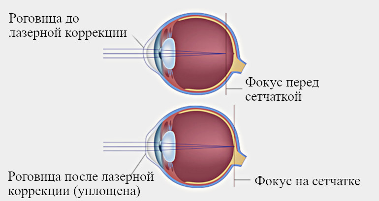 Почему улучшается зрение после лазерной коррекции