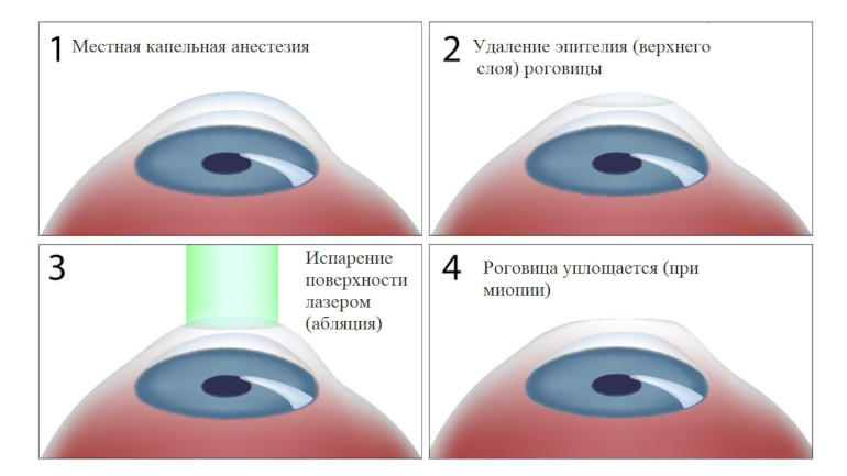 Коррекция зрения по методу ФРК