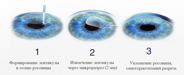 ReLEx SMILE - технология лазерной коррекции зрения 3-го поколения