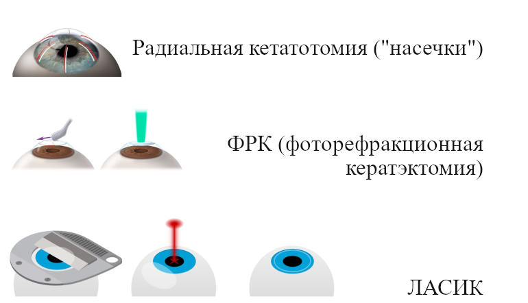Эволюция технологий восстановления зрения - от радиальной кератотомии до ЛАСИК