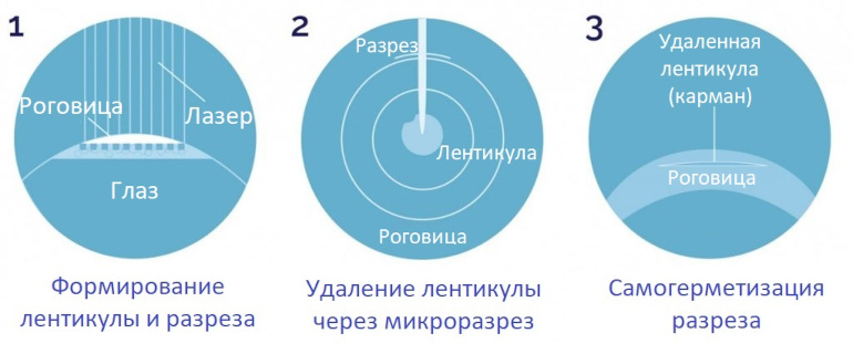 Схематические этапы операции SmartSight